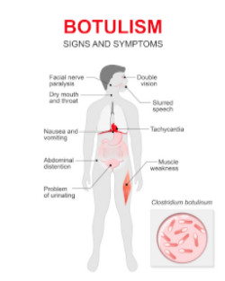 Botulismus Symptome