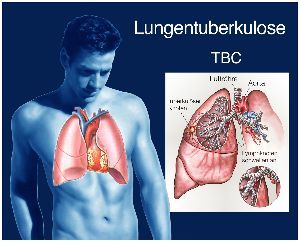 Tuberkulose